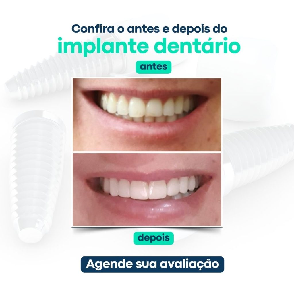 antes e depois de implantes dentarios