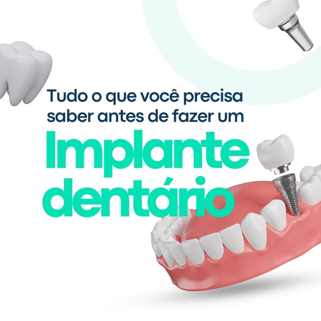 tudo sobre implante dentário